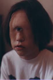 IM A  CYCLOPS   BECAUSE OF ACID