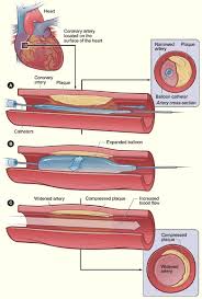 Coronary Balloon  Angioplasty 