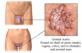HPV