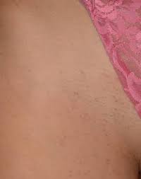 After Laser Hair Removal