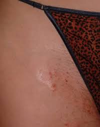 Before Laser Hair Removal