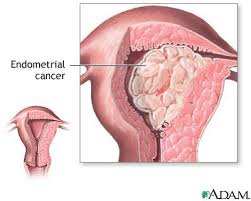 Endometrial  cancer 