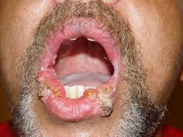  genital warts  on lips
