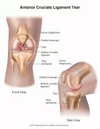  Anterior Cruciate Ligament 