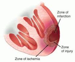 http://img.tfd.com/dorland/thumbs/infarction_myocardial.jpg