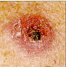 Melanoma,  skin cancer ,