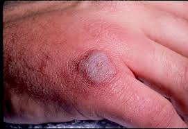 methicillin-resistant S. - via Daymix