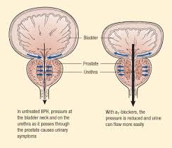 Prostate UK BPH Drug treatment