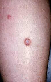 http://www.skincareguide.ca/images/glossary/clear_cell_acanthoma.jpg