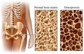 (osteoporosis) is - via Daymix