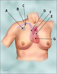 Port for Chemotherapy - via Daymix