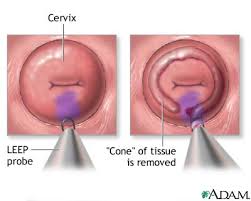  Cervical dysplasia  - series