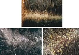 severe  dandruff /seborrheic
