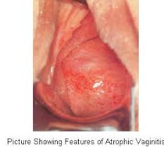 bloody  vaginal discharge .