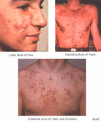 http://www.healthgiants.com/wp-content/uploads/2009/12/acne_vulgaris_on_human_body.gif