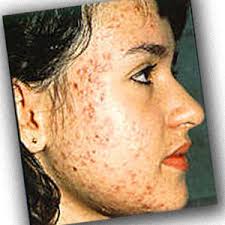 Treating  Acne  Blemishes
