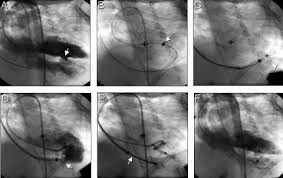 mid muscular VSD arrow B