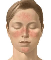 treat  rosacea 