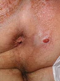 https://meded.ucsd.edu/clinicalimg/gu_perirectal_abscess2.jpg