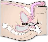 Pundendal Nerve  Stimulation   using    