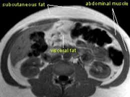 In this  abdominal MRI scan ,