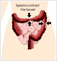  Irritable bowel syndrome 
