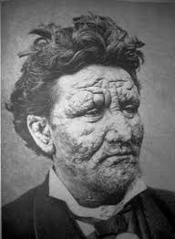 Leprosy - via Daymix