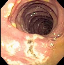 Zollinger-Ellison syndrome  is