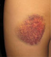  Bruise 