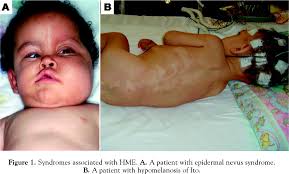  Proteus syndrome, 