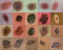  Melanoma's  Staging System