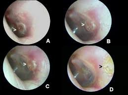  myringotomy scar: (A) one week, 