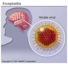 http://www.ghi.com/yourhealth/encyclopedia/articles/encephalitis.jpg