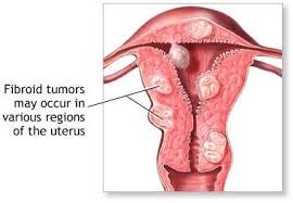  retroversion  of  the uterus 