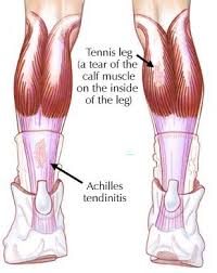  Achilles tendinitis  involves