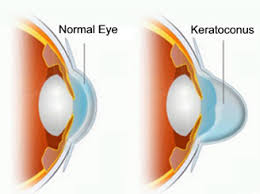  Keratoconus  - The Eyeglass