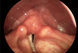 VOCAL FOLD PARALYSIS: - via Daymix