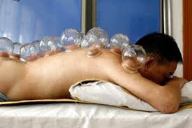chinese-acupuncture-cupping.
