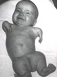 WHAT DID THALIDOMIDE PRODUCE? - via Daymix