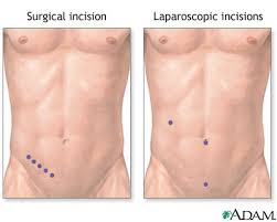  Appendectomy  - series