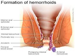 Unlike with internal hemorrhoids