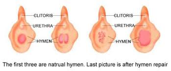 Hymen Repair - 处女膜修复