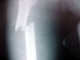 http://www.clinicadevita.com.br/imagens/fraturas_01.jpg