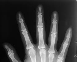 http://uwmsk.org/static/residentprojects/hyperparathyroidismhand2.jpg