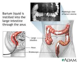 Barium Enema X-Ray