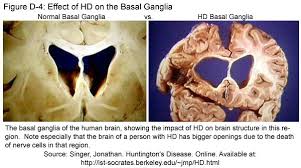  people with Huntington�s disease 
