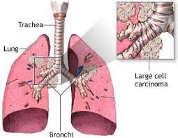  Lung Cancer  is the
