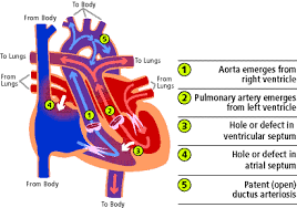  cyanotic  congenital  heart 
