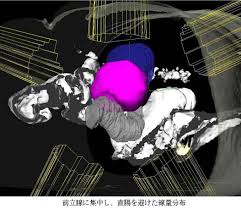 生活習慣の欧米化のためか前立腺