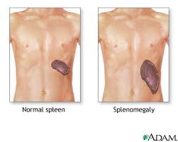  Splenomegaly 
